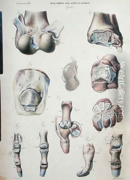 Diseases of the joints, from 'Anatomie Pathologique du Corps Humain' Oil Painting - Antoine Chazal