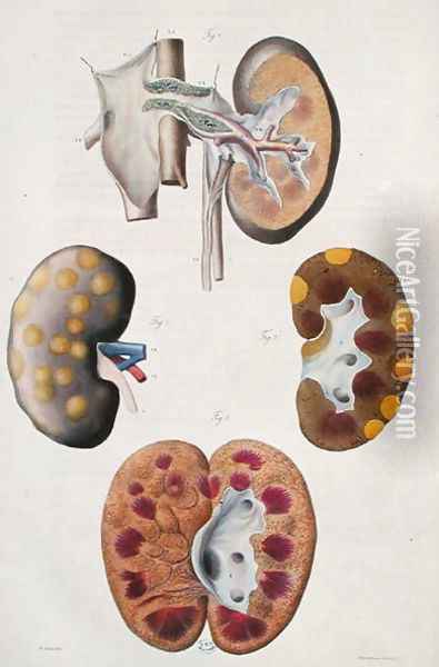 Diseases of the kidneys, from 'Anatomie Pathologique du Corps Humain' Oil Painting - Antoine Chazal