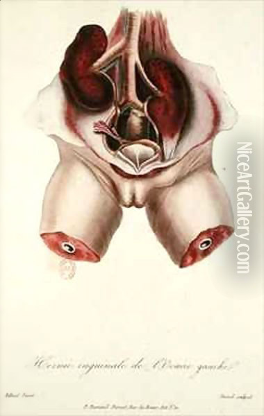 Inguinal hernia of the left ovary, from 'Traite des Maladies des Enfans Nouveaux-Nes et a la Mamelle' Oil Painting - Charles-Michel Billard