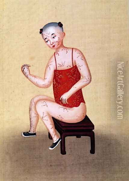 Child with smallpox (2) Oil Painting - Anonymous Artist