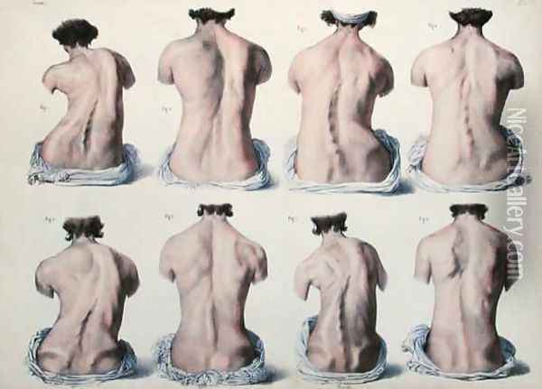 Spinal Deformities Oil Painting - Nicolas Henri Jacob