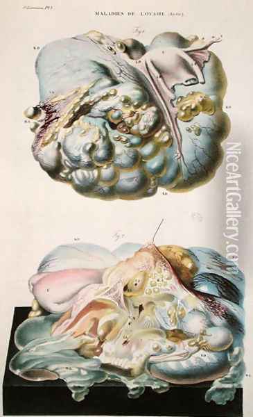 Diseases of the Ovaries, from 'Anatomie Pathologique du Corps Humain' Oil Painting - Antoine Chazal