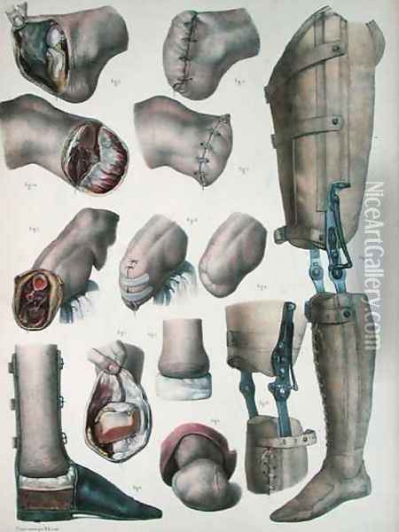 Amputations and Prosthetics Oil Painting - Nicolas Henri Jacob