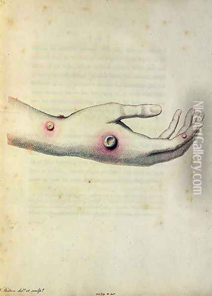 Cowpox pustule on the arm of Sarah Nelmes, from An Inquiry into the Causes and Effects of the Variolae Vaccinae by Edward Jenner 1749-1823 engraved by Pearce, c.1800 Oil Painting - William Skelton