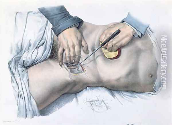 Tying up an artery Oil Painting - Nicolas Henri Jacob
