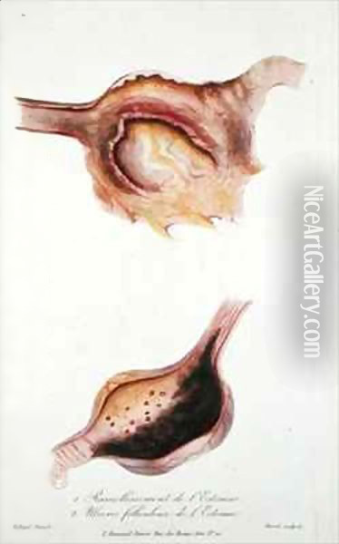 Softening and follicular ulcers of the stomach, from 'Traite des Maladies des Enfans Nouveaux-Nes et a la Mamelle' Oil Painting - Charles-Michel Billard