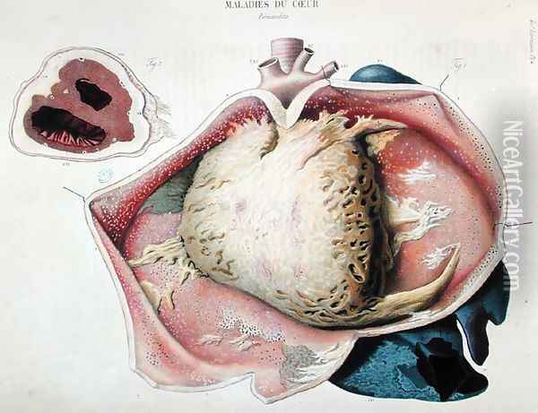 Pericarditis, plate depicting heart diseases from 'Anatomie pathologique du corps humain' Oil Painting - Antoine Chazal