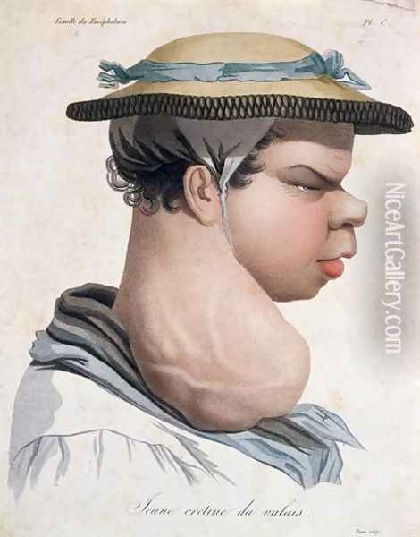 Young Cretin from Valais, illustration from a book by Baron Jean Louis Alibert 1768-1837 Oil Painting - Salvadore Tresca