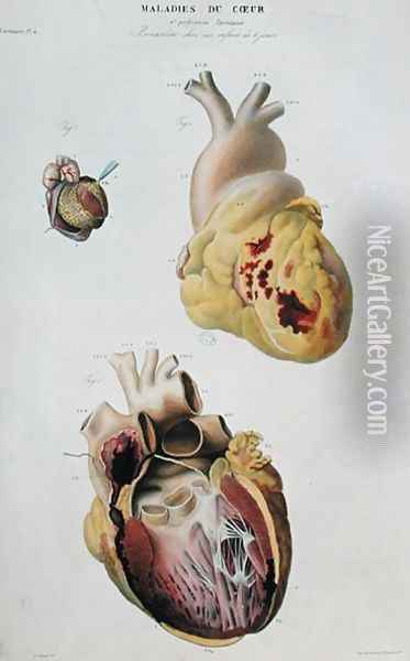 Plate depicting heart diseases. Spontaneous rupture of the heart of an 86 year old woman (fig. 1) and pericarditis in a six day old baby (fig. 2), from 'Anatomie pathologique du corps humain', 1828-42 Oil Painting - Antoine Chazal