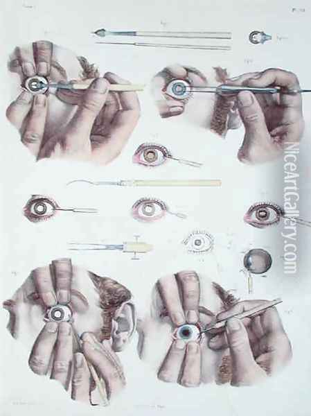 Operation on a eye Oil Painting - Nicolas Henri Jacob