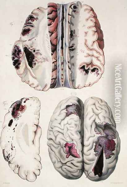 Capillary apoplexy, from 'Anatomie Pathologique du Corps Humain', 1828-42 Oil Painting - Antoine Chazal