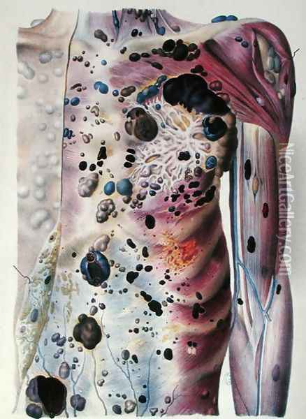 Tumours and cancerous tubercles, from 'Anatomie Pathologique du Corps Humain', 1828-42 Oil Painting - Antoine Chazal