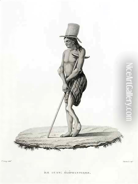 Guam: A Man with Elephantiasis, from 'Voyage Autour du Monde sur les Corvettes de L'Uranie 1817-20' Oil Painting - Jacques Etienne Victor Arago