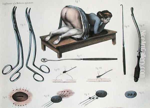 An operation on a vesicovaginal fistula Oil Painting - Nicolas Henri Jacob